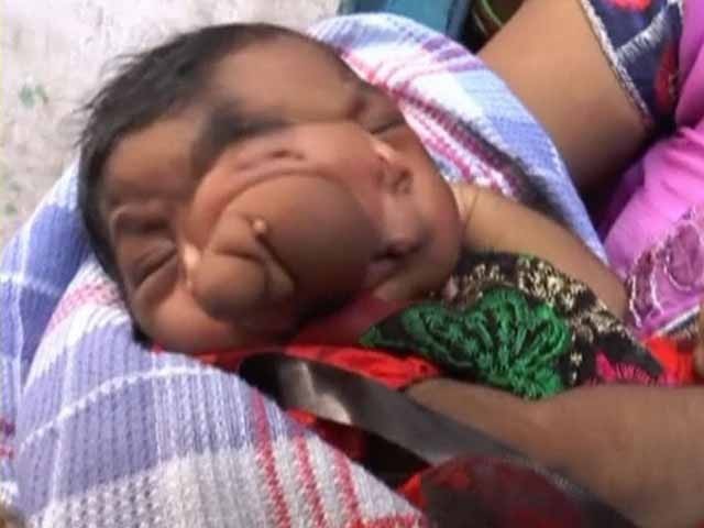 بھارت میں ہندوؤں نے عجیب الخلقت نوزائیدہ بچی کو بھگوان قرار دے دیا